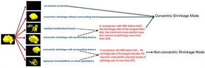 Mutant Allele Frequency-Based Intra-Tumoral Genetic Heterogeneity Related to the Tumor Shrinkage Mode After Neoadjuvant Chemotherapy in Breast Cancer Patients